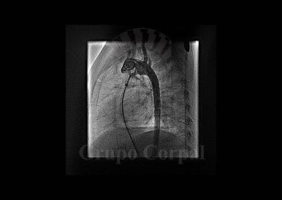Ductus Arterioso persistente, imagen 4