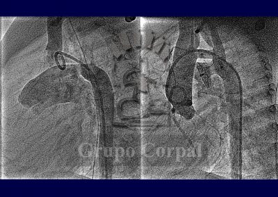 Ductus Arterioso persistente, imagen 7