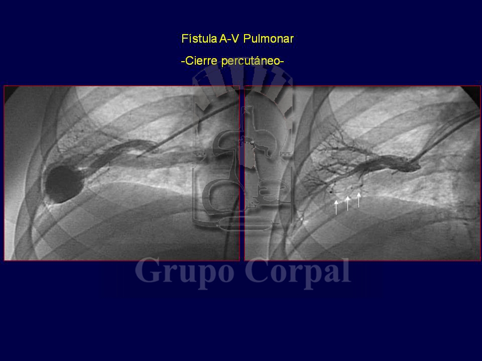 Closure of arterial-venous and venous-systemic fistulas