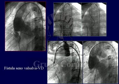 Fistulas arterio-venosas y veno-sistémicas imagen 5