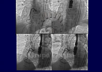 Fistulas arterio-venosas y veno-sistémicas imagen 8