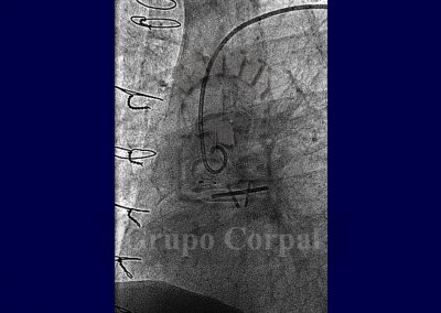 Fistulas arterio-venosas y veno-sistémicas imagen 9