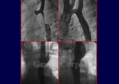 Implantación de stent en la coartación de aorta imagen 2