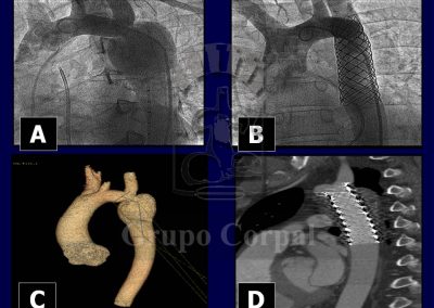 Implantación de stent en la coartación de aorta imagen 4