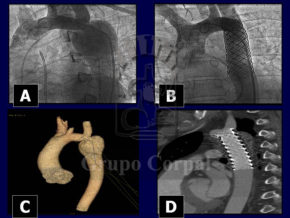 Implantación de stent en la coartación de aorta 
