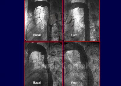 Implantación de stent en la coartación de aorta imagen 5