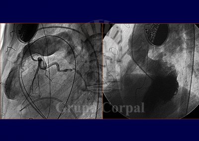 Implantación percutánea de válvulas pulmonares imagen 3