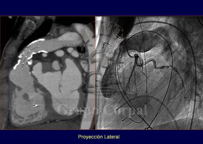 Implantación percutánea de válvulas pulmonares imagen 4