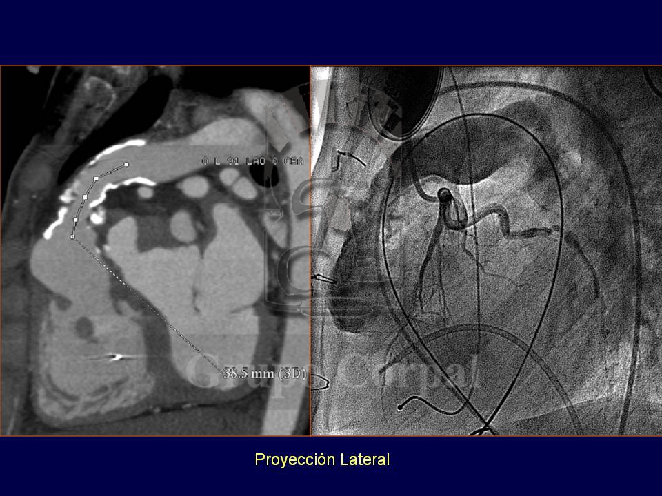 Percutaneous implantation of pulmonary valves