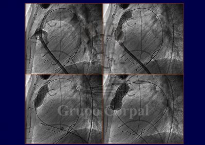 Implantación percutánea de válvulas pulmonares imagen 5