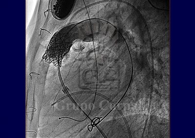 Implantación percutánea de válvulas pulmonares imagen 6