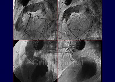 Implantación percutánea de válvulas pulmonares imagen 7