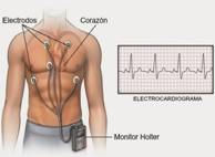 Holter electrocardiogram 