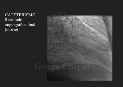 Miocardiopatía Hipertrófica Obstructiva (MHO)