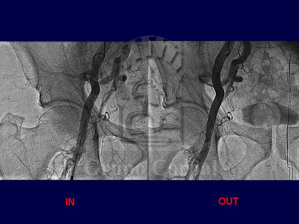  Pseudoaneurysm at the arterial puncture site. 
