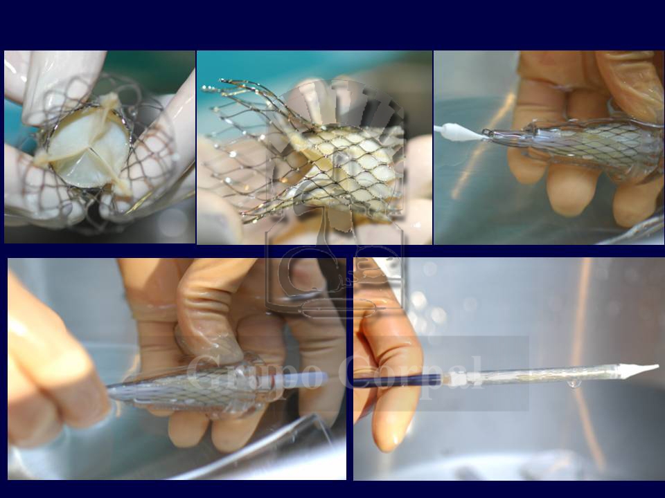 Implantacion de válvula aórtica