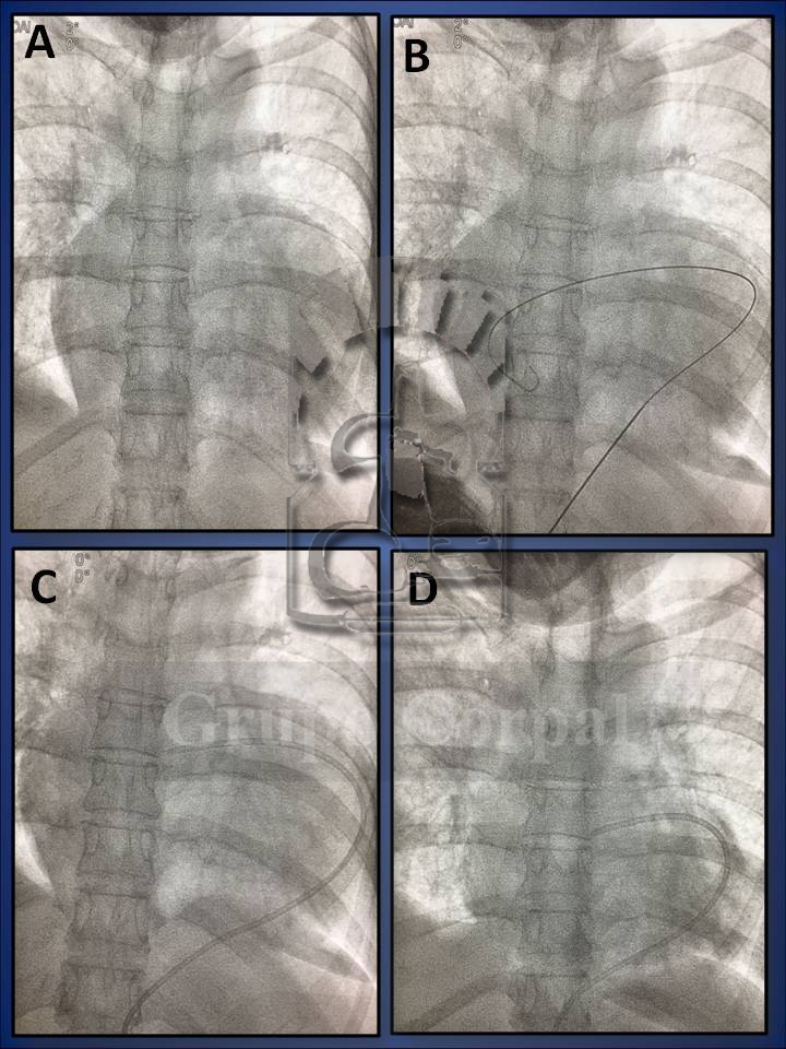 Pericardiocentesis, treatment that avoids the “Pericardial Taponade”
