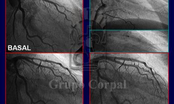 Coronariografía Selectiva en el Infarto de Miocardio