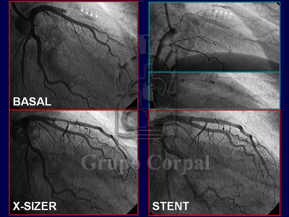 Coronariografía Selectiva en el Infarto de Miocardio, imagen mes de febrero 2017