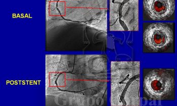 Paciente con síndrome coronario agudo antes y después del implante de un stent, imagen mes de abril 2017