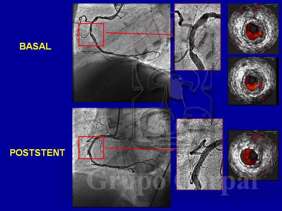 Imagen mes de abril 2017, Imágenes de un paciente con síndrome coronario agudo, por placa complicada en la coronaria derecha, antes y después del implante de un stent. 