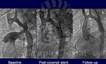 Imágenes de paciente con coartación de aorta