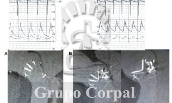 Obliteración percutánea de fuga periprotésica masiva