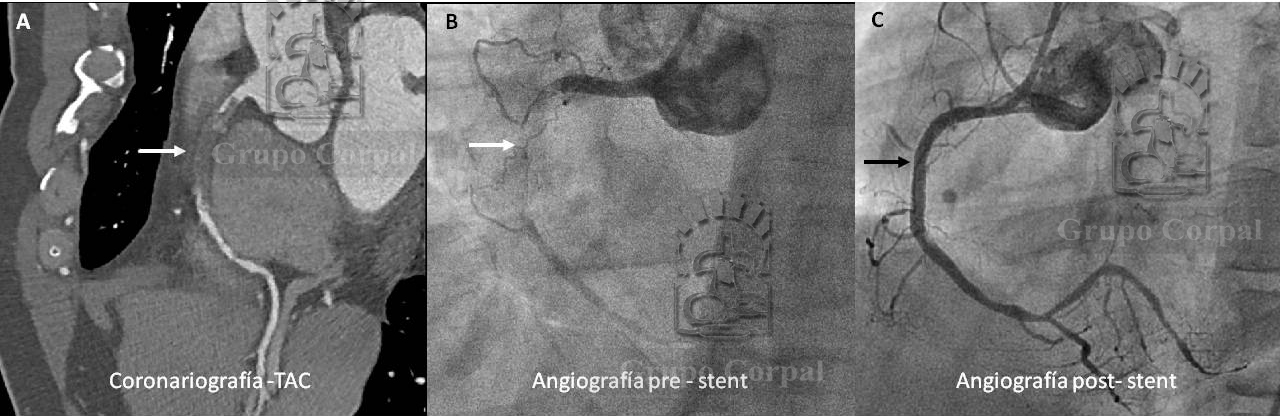 Imágenes de paciente con enfermedad coronaria por oclusión de arteria coronaria derecha, quien fue tratado con reperfusión y recubrimiento con stents.