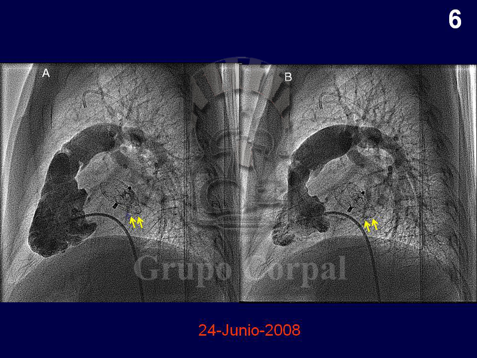 Angiogramas de ventrículo derecho en diástole y sístole después del cierre definitivo con el dispositivo de Amplatz