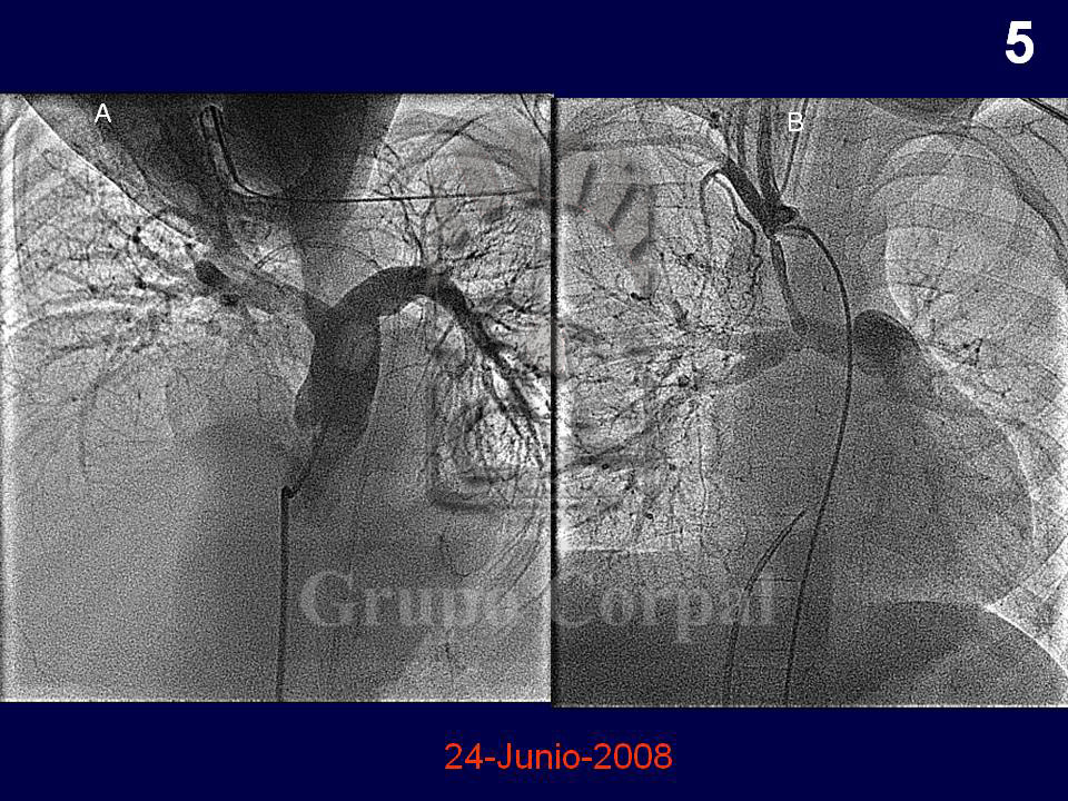 Inyección contraste en la arteria pulmonar en proyección 4-cámaras a través de un catéter globo angiográfico