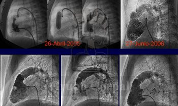 Desarrollo evolutivo del ventrículo derecho en un niño con Atresia Pulmonar con septo íntegro