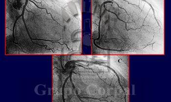 Imagen de paciente con historia reciente de angor progresivo