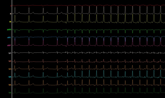  Electrocardiograma basal. Se muestra PR corto y onda delta, características del síndrome WPW.