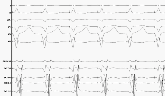 Figura 2 B.- Mediante estimulación programada desde ápex de VD se objetiva VA más corto a nivel del seno coronario distal (SC 1-2), sugiriendo localización de la vía a nivel lateral izquierda.