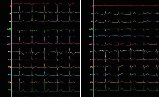 Se muestran los electrocardiogramas antes y tras la ablación de la vía accesoria.
