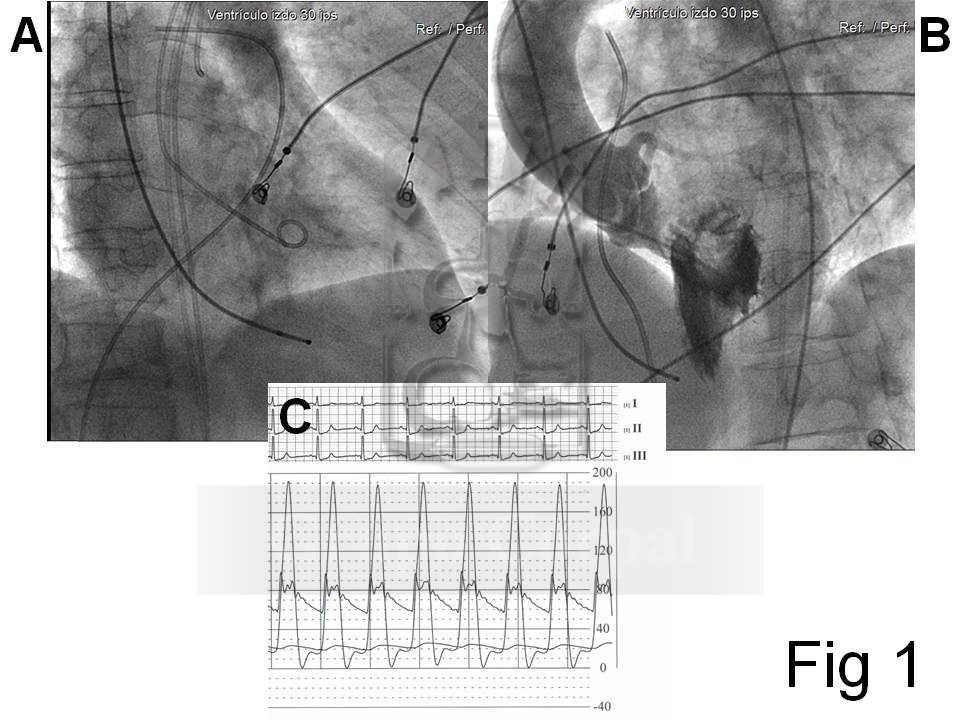 Se muestra en A la ubicación de los catéteres y la monitorización ; En B puede observarse una ventriculografía izquierda; C muestra el registro de presiones simultáneas en ventrículo izquierdo, aorta y arteria pulmonar.