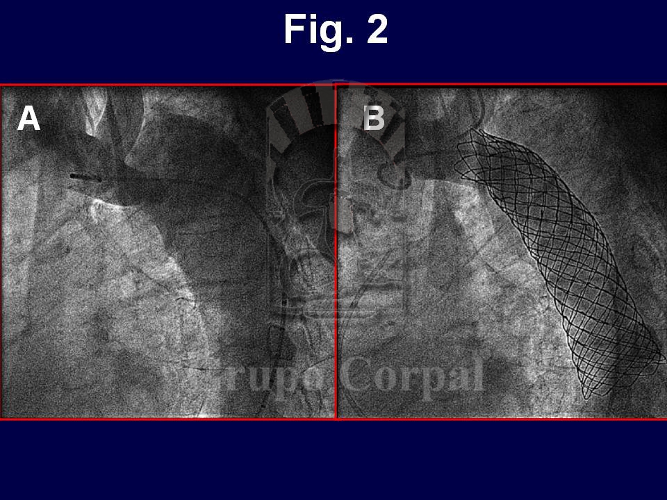 Imágenes angiográficas de aorta (proyección OAI 60 grados) antes (A) y después (B) del implante.