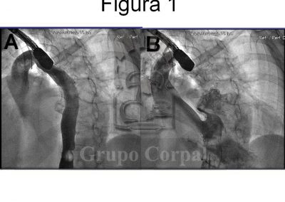 Cavografía inferior en proyección 4-cámaras a través de catéter globo Bergman angiográfico