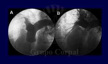 Tratamiento percutáneo del embolismo pulmonar agudo