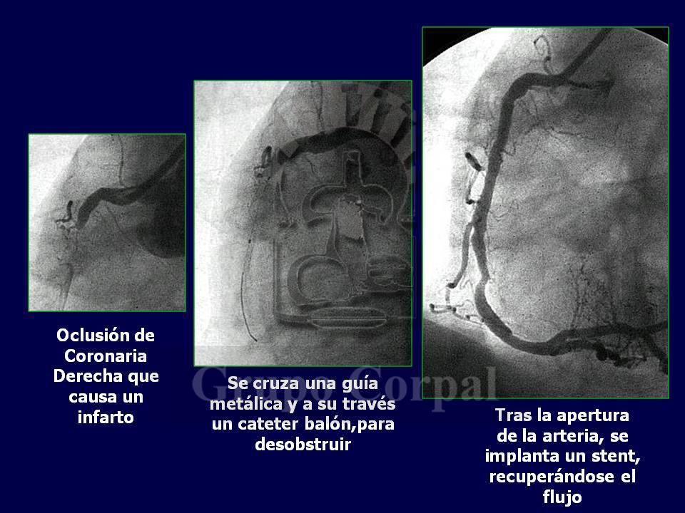 Imagen mes de febrero 2018, Paciente con infarto agudo de miocardio. Se procede a realizar cateterismo.