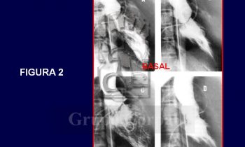 Paciente con Estenosis Subaórtica de Membrana fina tratada con dilatación con balón