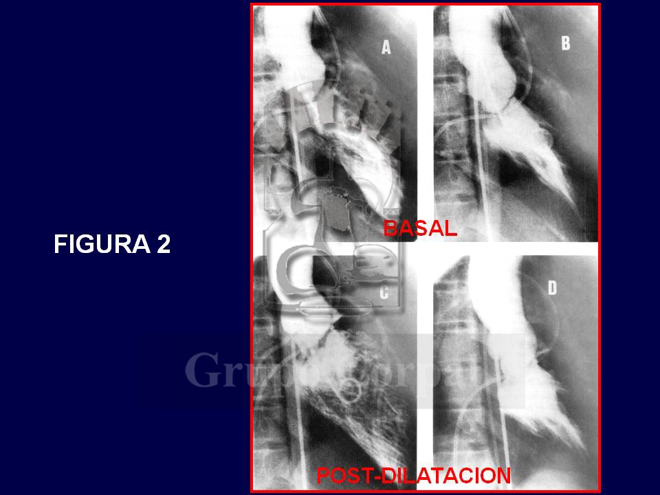 Ventriculogramas en diástole (A,C) y en sístole (B,D), antes y después del tratamiento . Imágenes mes de abril 2018