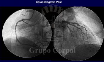 Reconstrucción arterial con stents en paciente con oclusión crónica de arteria Coronaria Derecha