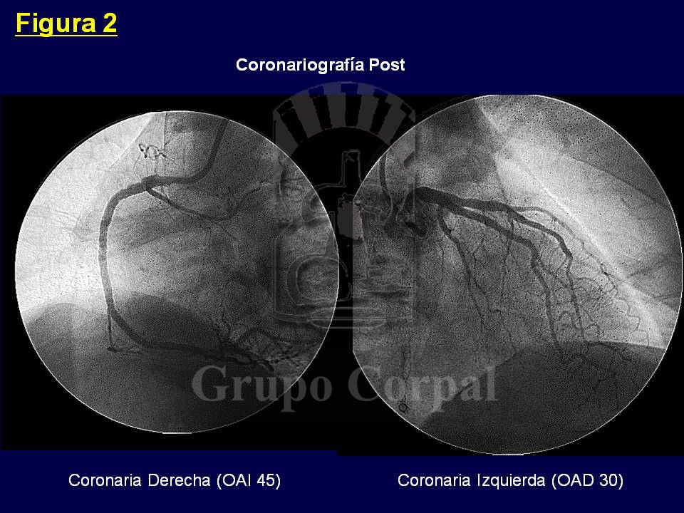 Imagen mes de mayo 2018, Coronariografías tras el tratamiento. 
