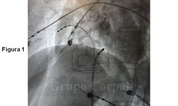Taquicardia paroxística supraventricular (TPSV), estudio electrofisiológico