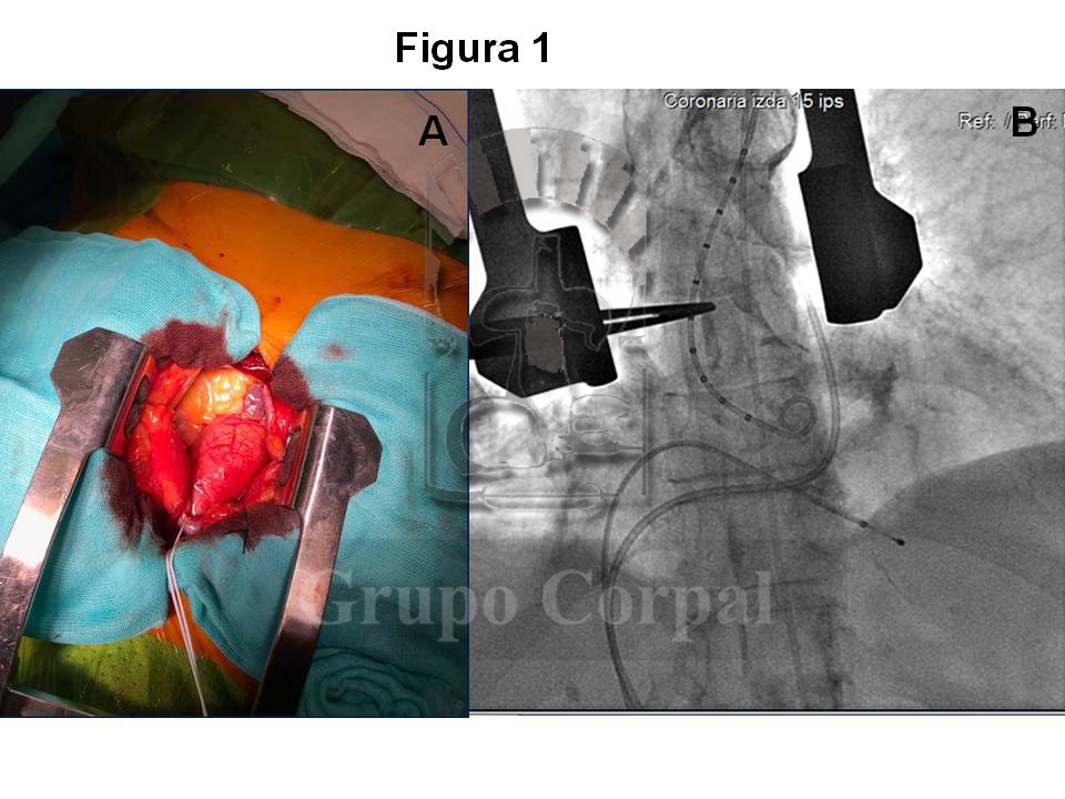 Esternotomía superior para mostrar la pared anterior de la aorta