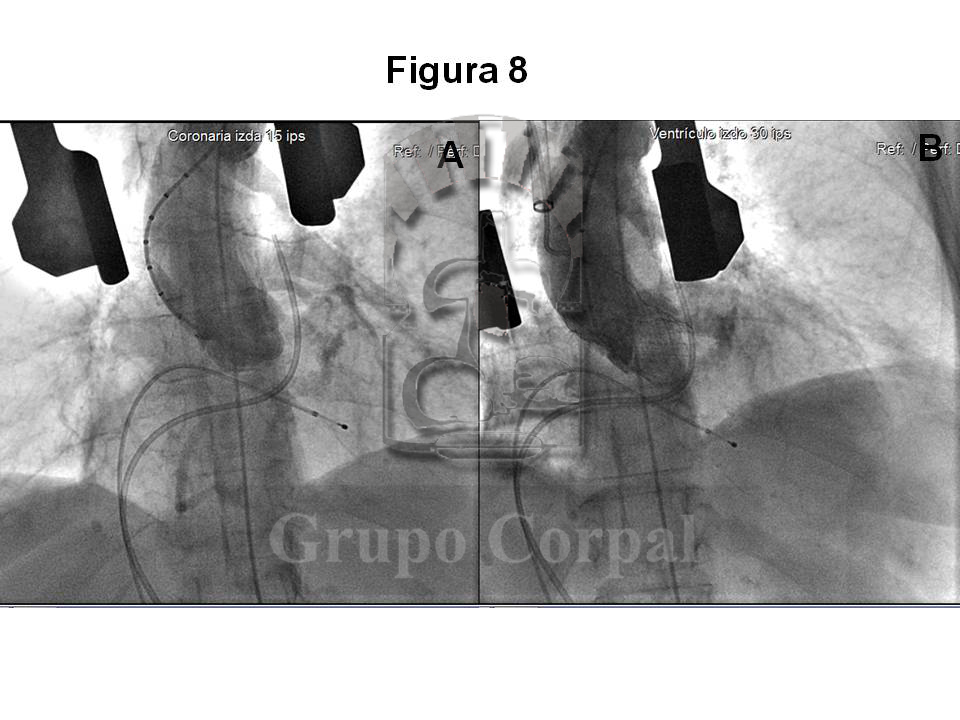 Aortografías comparativas. A: basal. B: post-implante. 