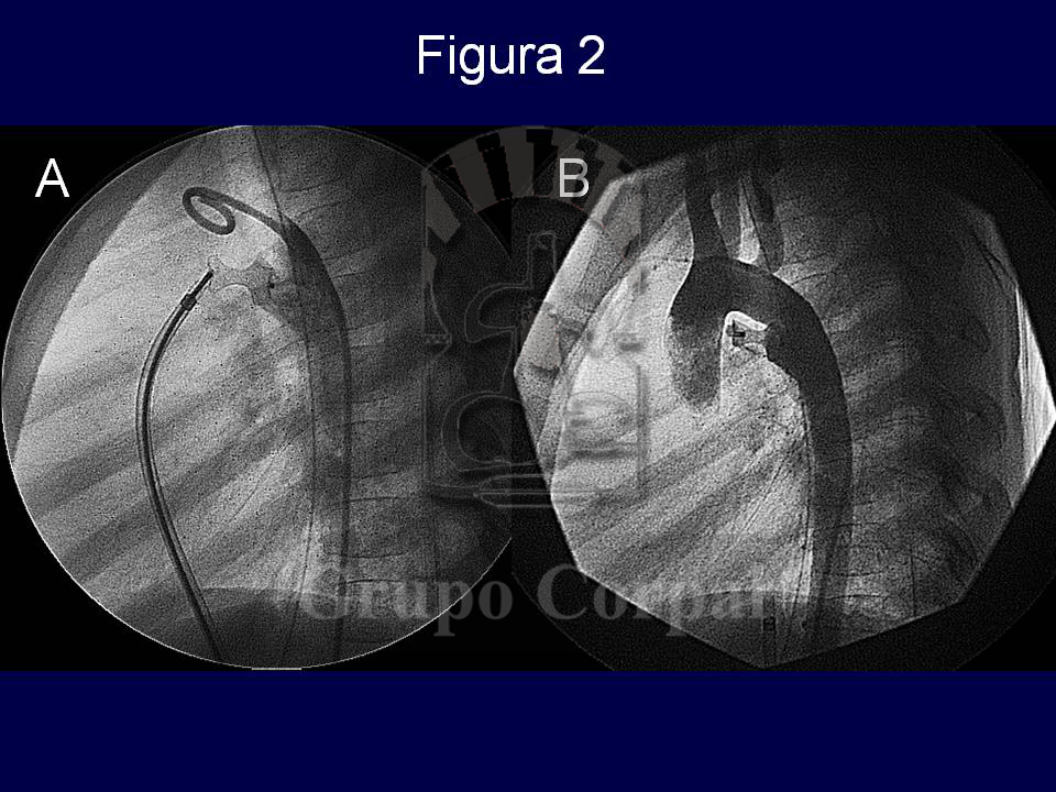 Imágenes mes de junio 2018, Angiograma para mostrar la adecuada posición del dispositivo de Amplatz implantado en el Ductus