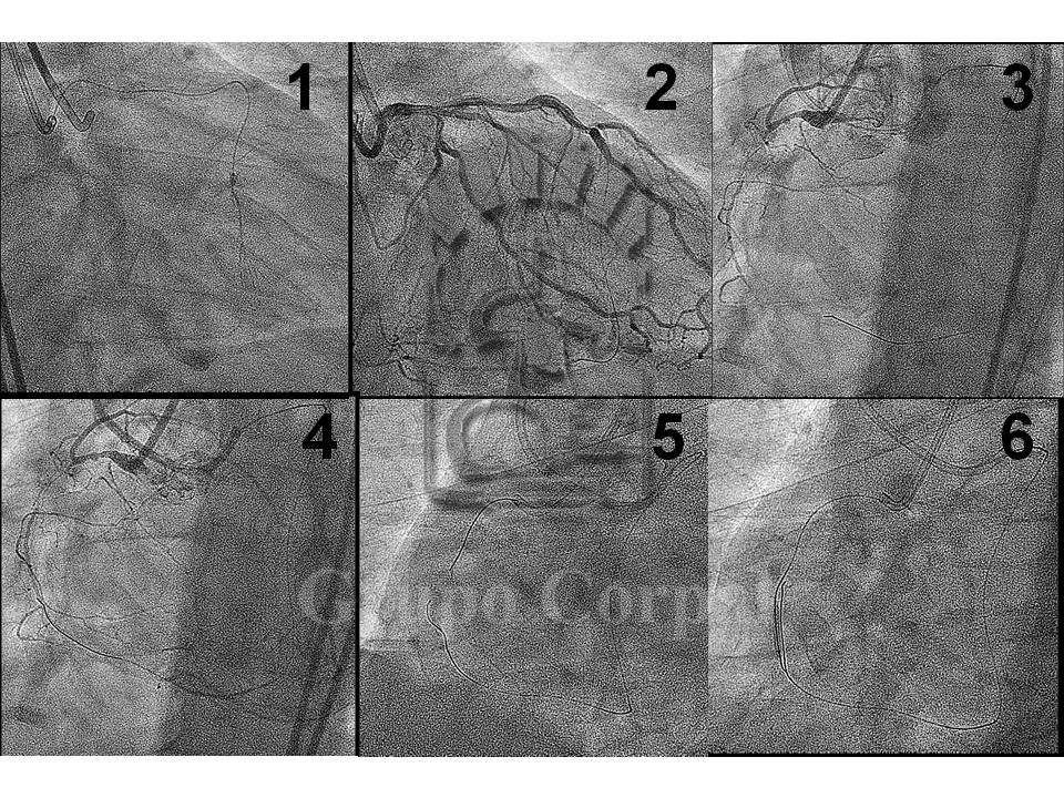 Imágenes de paciente de 58 años de edad con diagnóstico de isquemia miocárdica secundaria a oclusión crónica de la Coronaria Derecha, con amplia circulación colateral desde la Izquierda