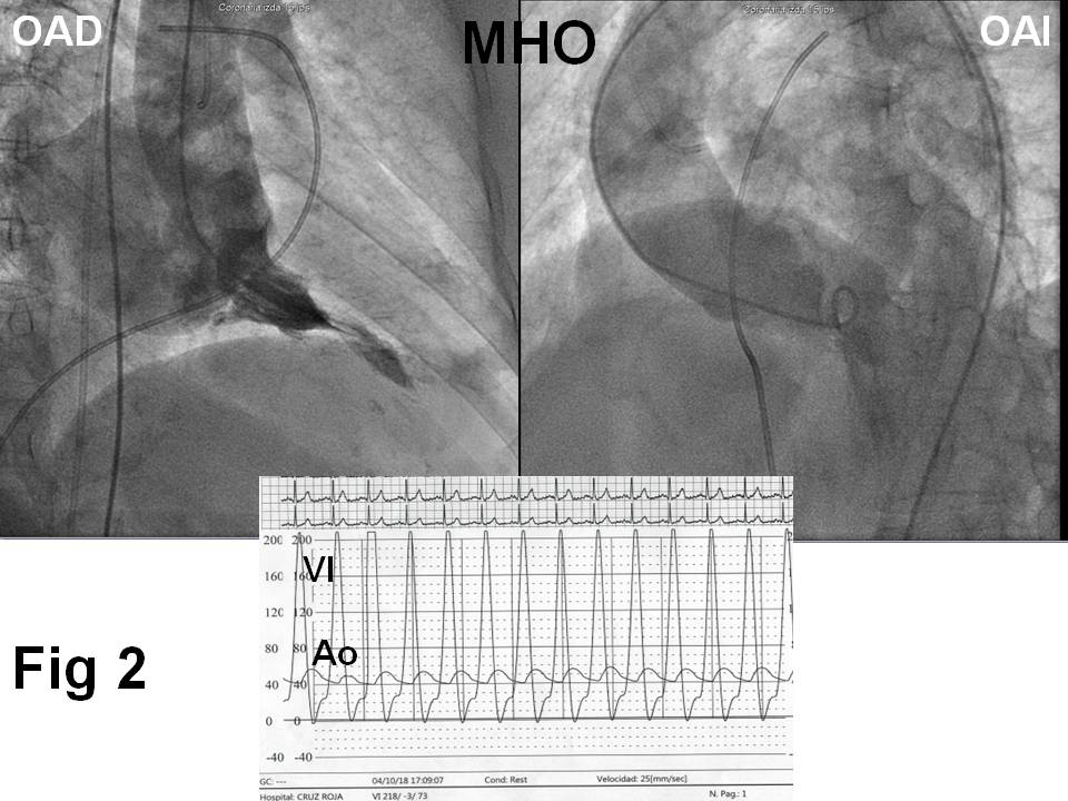 ventriculografías izquierdas, una en proyección OAD y otra en OAI - figura-2